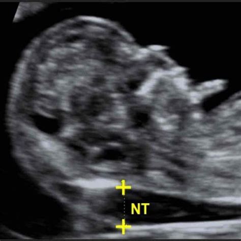 nuchal thickness at 12 weeks